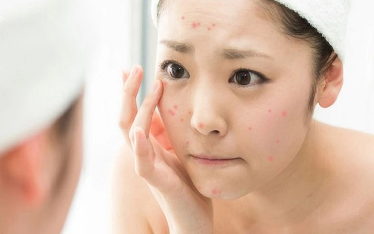 Vì sao mặt thanh niên dễ phát sinh nốt mụn?